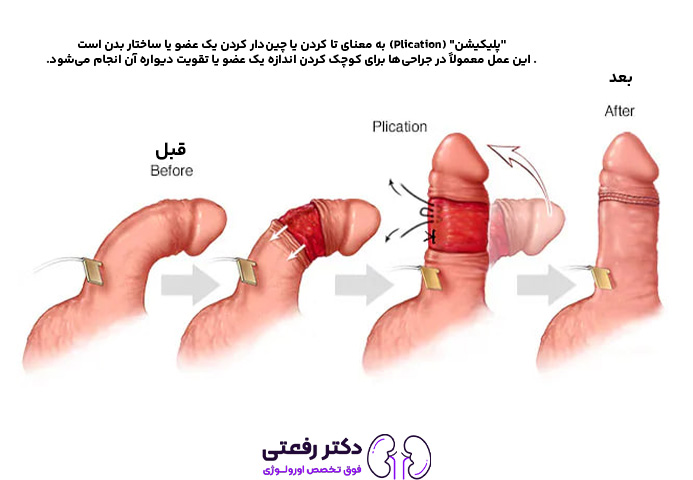 تجربه مردان از تزریق ژل به آلت تناسلی