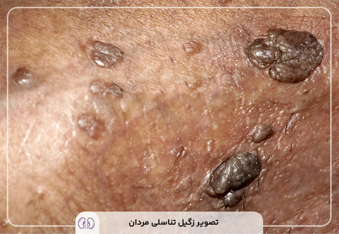 آیا زگیل تناسلی در مردان واگیردار است؟