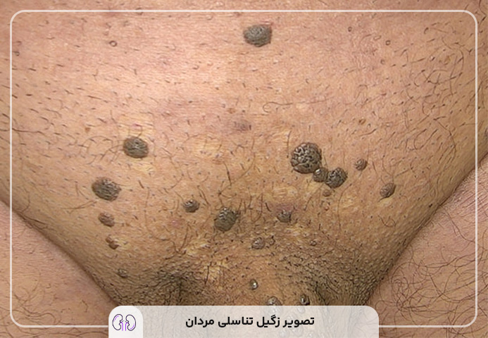 نحوه کرایو زگیل تناسلی